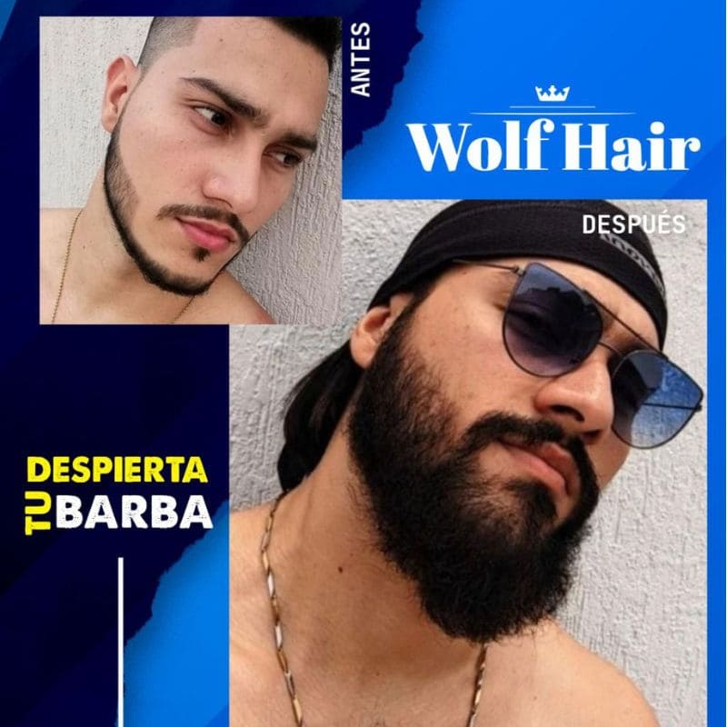 Minoxidil experiencia de usuario 2